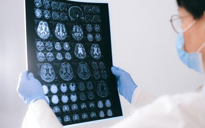 Use of Diagnostic Code 850 for Concussions